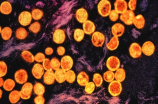 全球已有15个国家报告猴痘病例